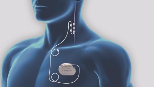 Vagus Nerve Stimulation (Discharge Care)