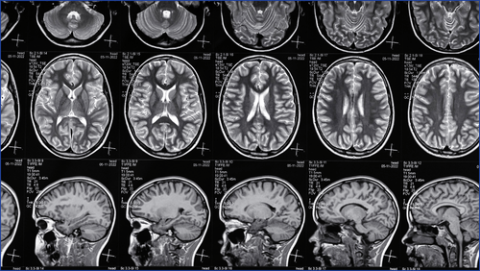 Pictures of a brain scan 